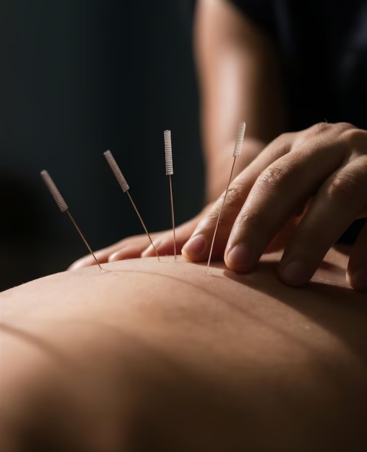 Acupuncture
