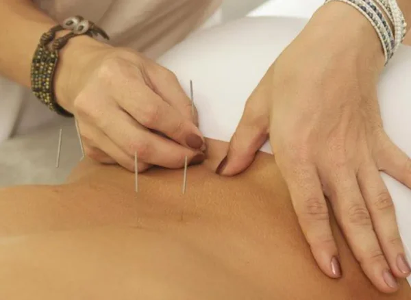 Acupuncture for Back Pain