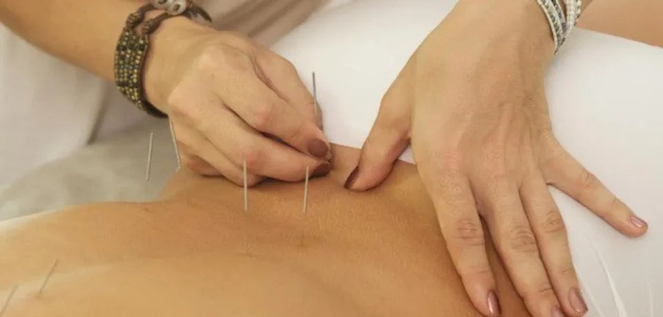 Acupuncture for Back Pain Acupuncture for Back Pain