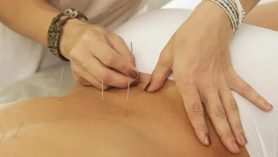 Acupuncture for Back Pain