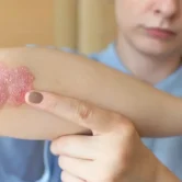 Psoriasis