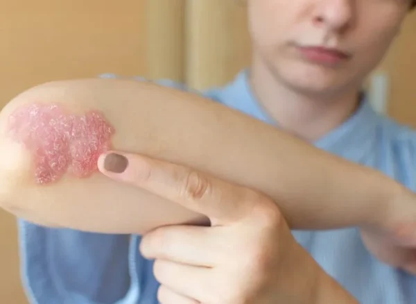 Psoriasis