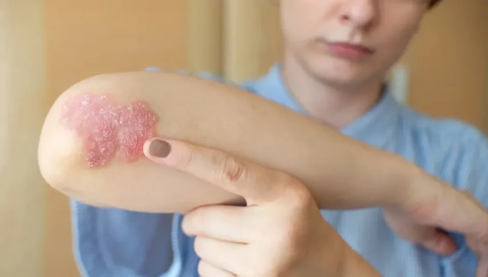 Psoriasis